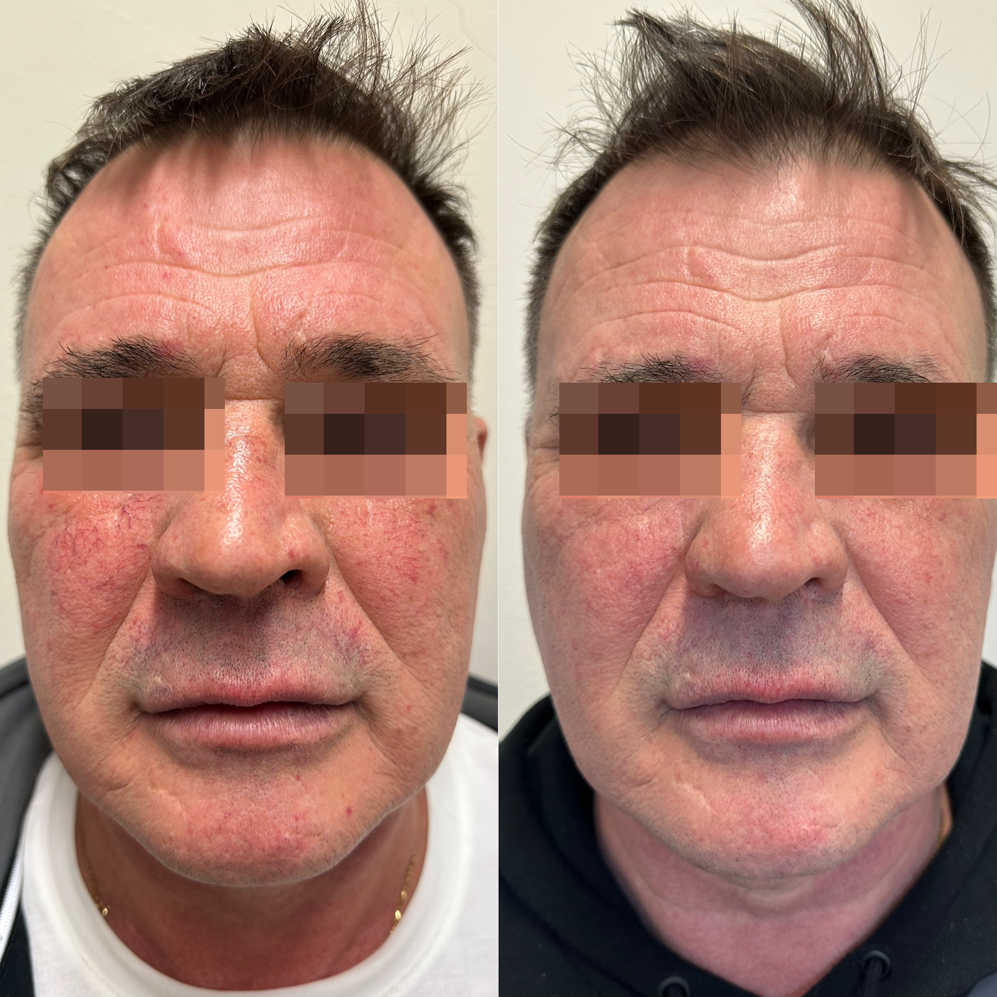 Cyspera® + ADVATx lézer rosacea kezelés eredmény